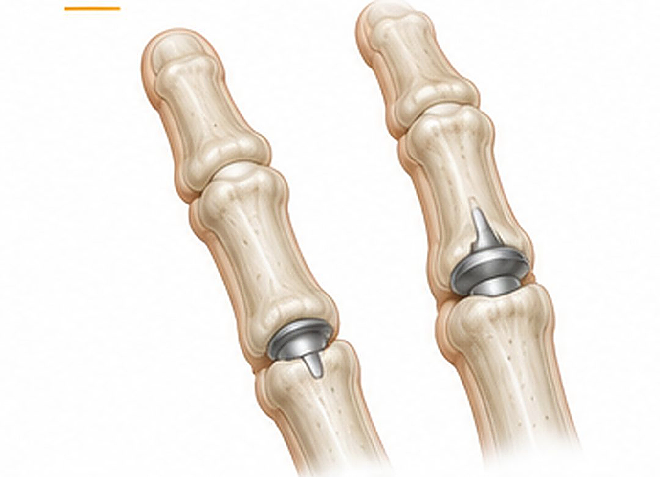 Arthroplastie interphalangienne