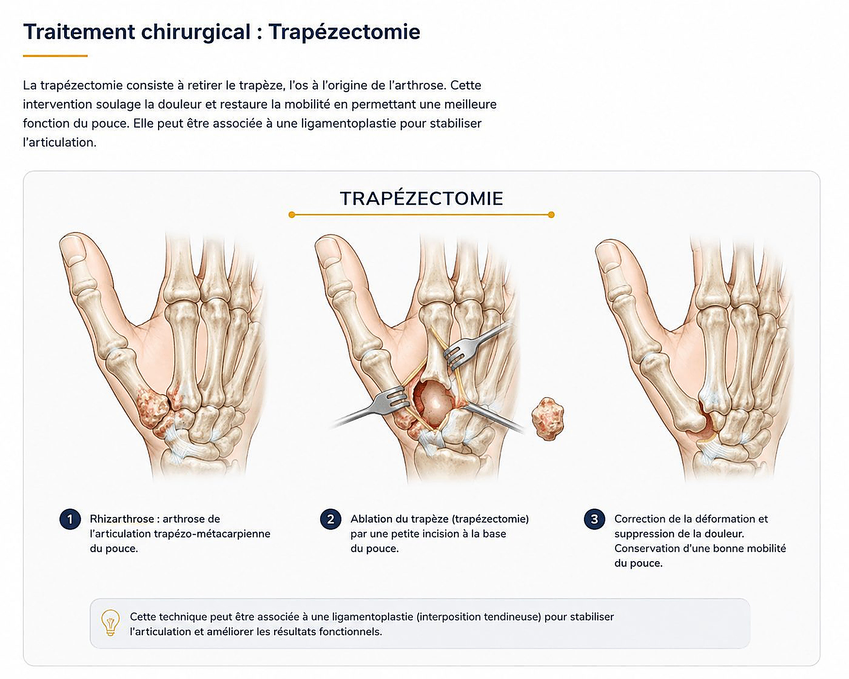 Illustration du traitement chirurgical : Rhizarthrose