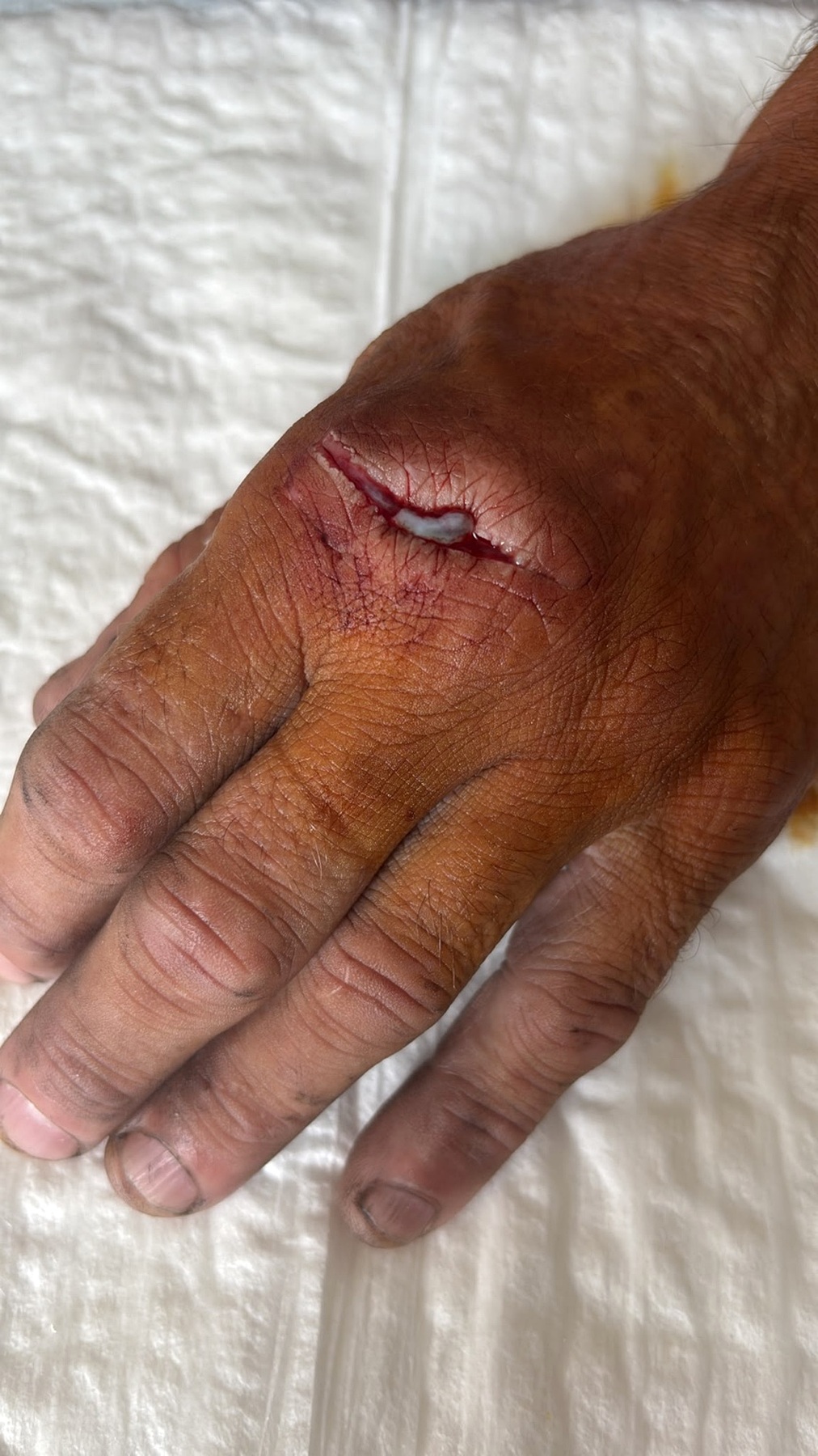 Plaie par disqueuse avec rupture des tendons extenseurs