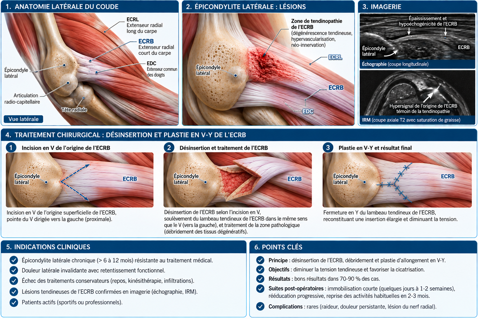 Illustration médicale : Épicondylite