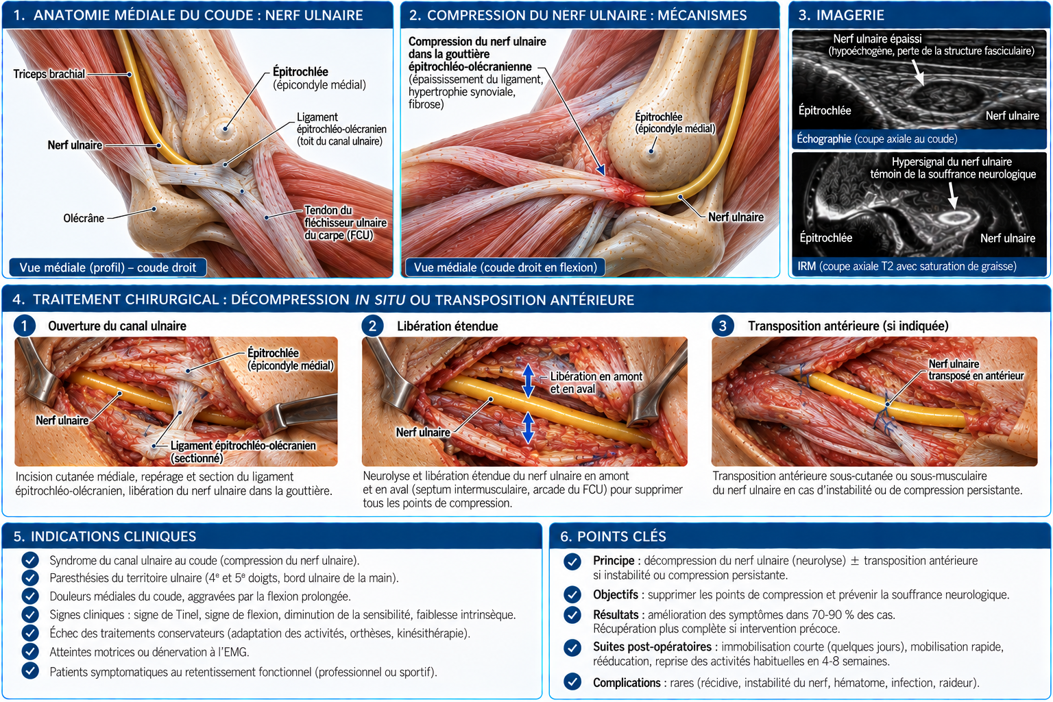Illustration médicale : Syndrome de compression du nerf ulnaire au coude